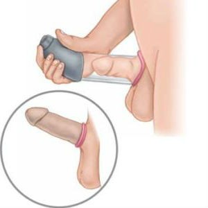 Bombas de Ereccion como funcionan